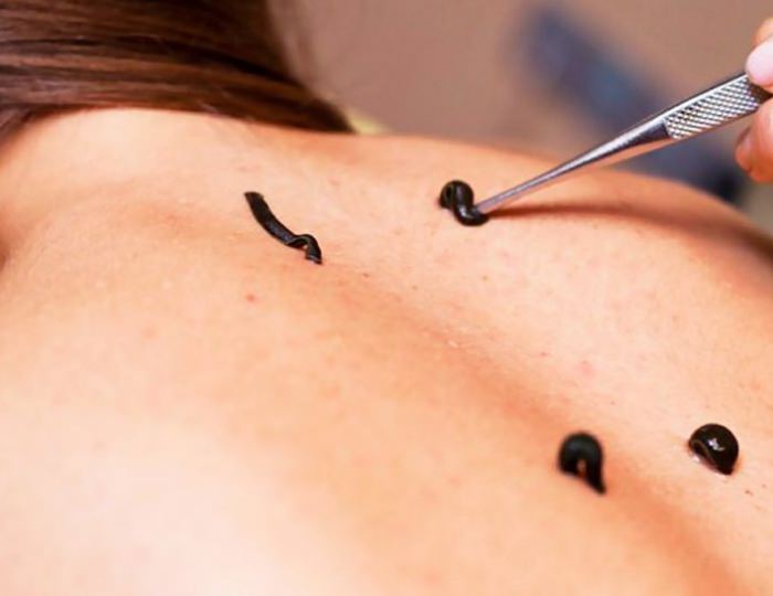 Гирудотерапия - Санаторий «Юность» Беларусь